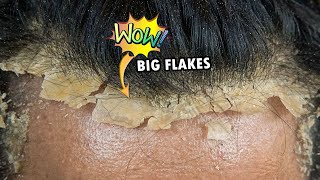 HUGE Flakes Of Dandruff On Scalp Removal 688 [upl. by Levin]