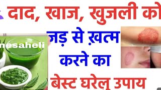 दाद खाज खुजली की 4 दिन में छुट्टी कर देगा Fungal Infection Treatment athome Daad Khaj Khujli ka ilaj [upl. by Dare]