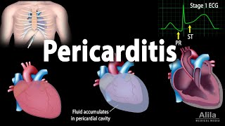 Pericarditis Symptoms Pathophysiology Causes Diagnosis and Treatments Animation [upl. by Ethel588]