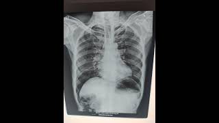 Peritonitis  pneumoperitoneum  chest x ray srivarihospital [upl. by Coppola]