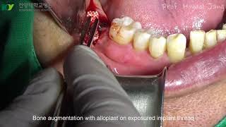 Surgical Regenerative Treatment of PeriImplantitis with TiBrush [upl. by Scevo]