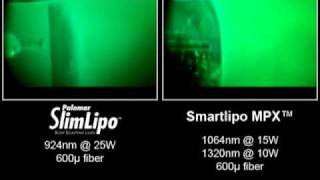 Video of Laser Liposuction Comparing SlimLipo vs SmartLipo and Lipotherme [upl. by Trinia264]