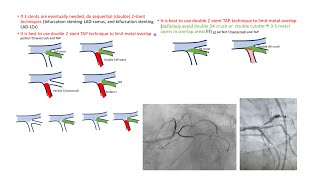 Left main trifurcation strategies [upl. by Opalina]