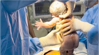 How is Cesarean Section LSCS done cesareanbirth csectionmom youtubevideos trending [upl. by Aidualc]