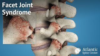 Facet Joint Syndrome [upl. by Airogerg61]