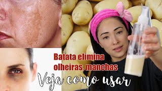 DICA COMO USAR BATATA PARA ELIMINAR OLHEIRASCLAREAR MANCHASDEIXAR SUA PELE DE PORCELANA [upl. by Eimmot]