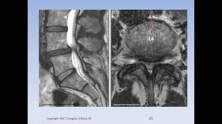 Lumbar Spinal Stenosis Cauda Equina Syndrome Sciatica amp Disc Herniation An Advanced Lecture [upl. by Adlar]