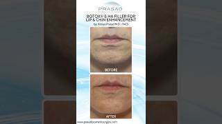 How Botox for Chin Dimpling Works botox [upl. by Naivaj]