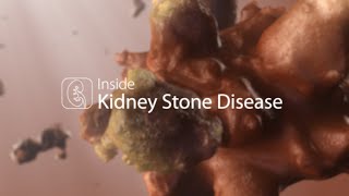 Medical Animation Kidney Stone Disease [upl. by Alpers]