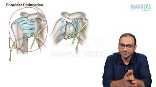 Orthopaedics  Anterior dislocation of shoulder  Marrow Edition 5 Clinical Core Sample Video [upl. by Laurin565]