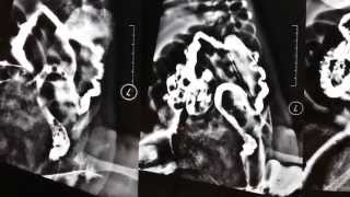 Barium enema in Hirschprungs disease [upl. by Hallock308]