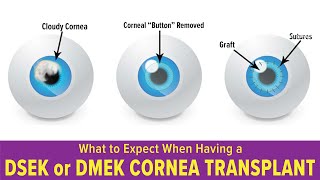 What to Expect When Having a DSEK or DMEK Cornea Transplant [upl. by Yllier]