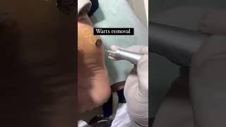 Warts removallaser treatmentlaserdermatologist Suratskin careskin specialist Surat [upl. by Orlov]