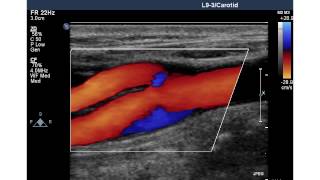 NORMAL CAROTID ARTERY [upl. by Syramad]