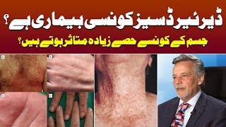 What is Darier Disease  Treatment of Dariers Disease  Keratosis Follicularis  Dr Raheel Karim [upl. by Eilac]