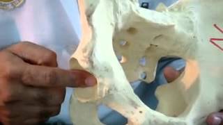 Salter’s innominate Osteotomy in Developemental Dysplastic Hip on Saw Bone Model [upl. by Tanhya]