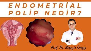 ENDOMETRİAL POLİP NEDİR💥 Rahim içi polip ve tedavisi [upl. by Jacey]