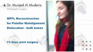 MPFL Reconstruction for Patellar Malalignment Dislocation  both knees  13 days post surgery [upl. by Htabmas]