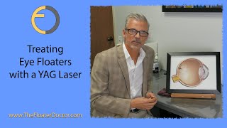 TREATING EYE FLOATERS WITH A YAG LASER BY THE FLOATER DOCTOR [upl. by Iot148]