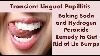 Transient Lingual Papillitis [upl. by Nyved850]