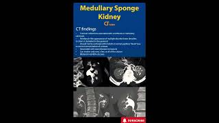 Medullary Sponge Kidney  CT  Radiology [upl. by Aiem]