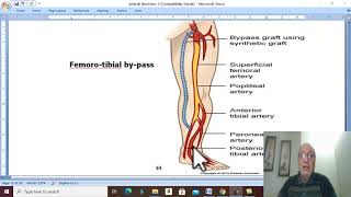 Arterial Disorders in Arabic 28  Buergers Disease  part 2   by Dr Wahdan [upl. by Llednil636]