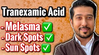 3 BEST Tranexamic Acids for Melasma and Discoloration not sponsored [upl. by Adelheid]