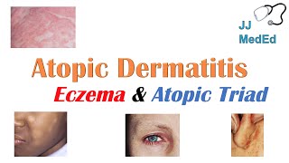 Eczema Atopic Dermatitis  Atopic Triad Triggers Who gets it Why does it happen amp Treatment [upl. by Phila611]