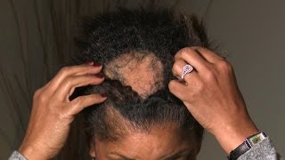 What Is Causing This Woman’s Extreme Hair Loss [upl. by Mulford]