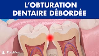 Problèmes de plombage dent – L’obturation dentaire débordée © [upl. by Nnywg]