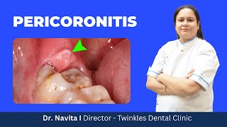 What is Pericoronitis  How does it occur How is it treated I Home remedies for Pericoronitis I [upl. by Araeit227]