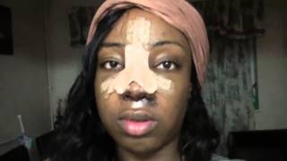 4 Revision Ethnic Rhinoplasty Nose Job Diary Day 3 After Surgery [upl. by Ynaffik]