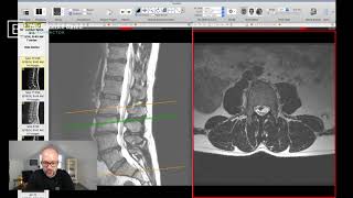 Clinical Series Lumbar Spinal Stenosis on MRI [upl. by Hanikas]