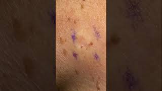 Age Spot Removal  Completely Gone [upl. by Padraig]