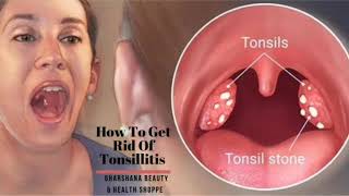 Sign of Tonsillitis Causes Symptoms and Treatment  How To Get Rid Of Tonsillitis [upl. by Attikram300]