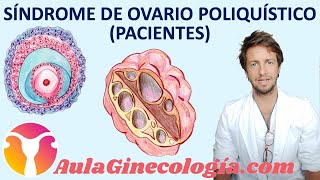 SÍNDROME DE OVARIO POLIQUÍSTICO PACIENTES SOP síntomas y diagnóstico  Ginecología y Obstetricia [upl. by Spring228]