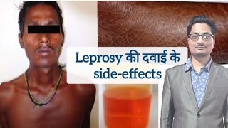 Leprosy की दवाइयों के sideeffects  Dapsone  Clofazimine  Rifampicin  Hansens disease leprosy [upl. by Herv]