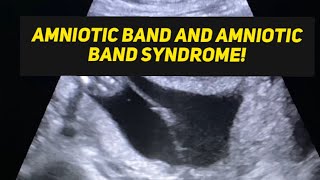 Amniotic band syndrome  learn ultrasound  ultrasound radiology [upl. by Glick972]