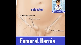 Femoral HerniaFemoral Canal Anatomy Groin HerniaInguinal Hernia SurgeryLap Hernia surgery [upl. by Anirrehs]