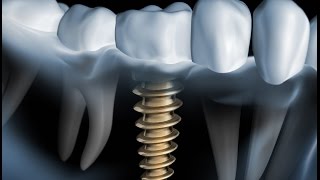 worauf kommt es an bei einem Zahnimplantat [upl. by Abdul480]