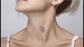 how to properly remove a hickey in minutes  hickey removal tricks [upl. by Vinita328]