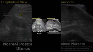 post partum uterus [upl. by Neellek]