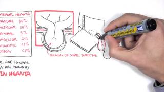 Introduction to Direct and Indirect Inguinal Hernia [upl. by Pleasant]