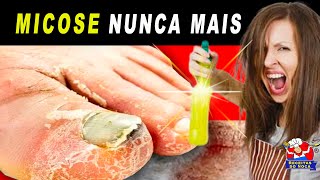 O melhor remédio para MICOSE DE UNHAS [upl. by Chaney853]