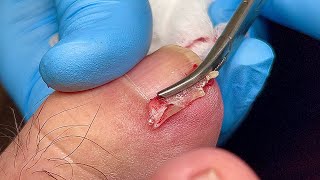 SATISYING INGROWN TOENAIL REMOVAL 😎 [upl. by Ko639]