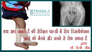 Dislocation of hip joint in cerebral palsy causes prevention amp treatment  Trishla Foundation [upl. by Oribel864]