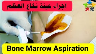 عينة نخاع العظم bone marrow biopsy جودة 4k [upl. by Reine]