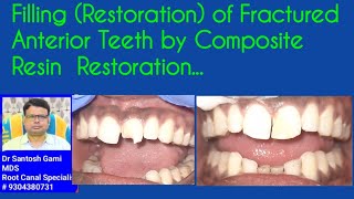 Filling Restoration of Fractured Anterior Teeth by Composite Resin Restoration [upl. by Adnolrehs]