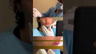 Chin Implant And Buccal Fat Removal  Sarayu clinics beauty facecontouring [upl. by Ennairoc]