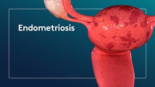 What is Endometriosis [upl. by Eidderf]